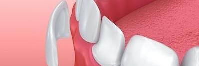 Porcelain veneer diagram