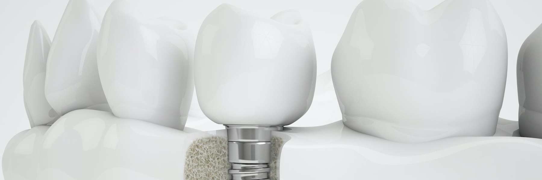 Root Canal vs Implant – Save or Replace Your Tooth