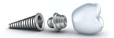 Diagram of a dental implant | Dentist Springfield, MO