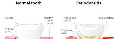 Periodontitis Diagram | Springfield MO Dentist