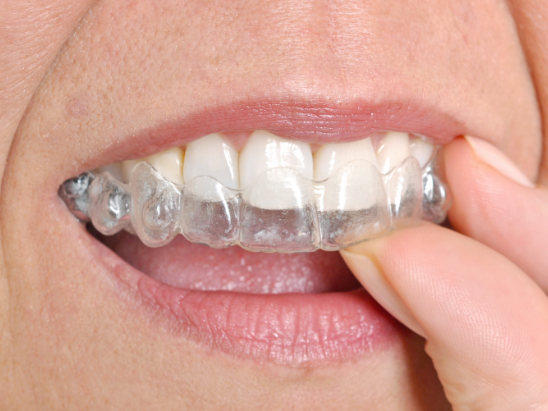 Invisalign In Springfield Mo Clear Braces White Smiles Invisalign In Springfield Mo Clear Braces White Smiles