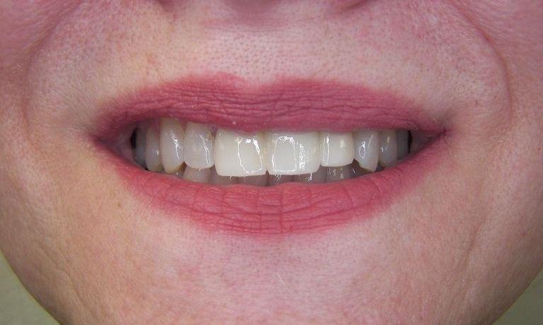 Dental patients smile after dental bridge procedure in Springfield MO