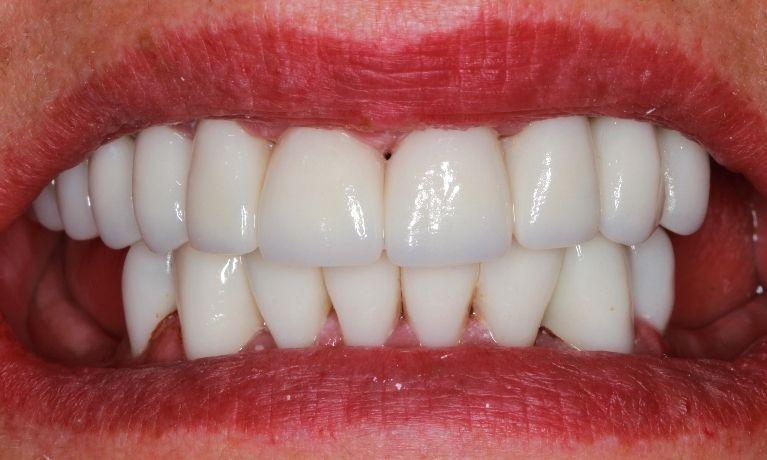 Results from dental crowns procedure in Springfield MO