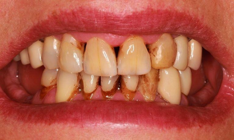 stained teeth with recession and damage at dentist office in Springfield MO