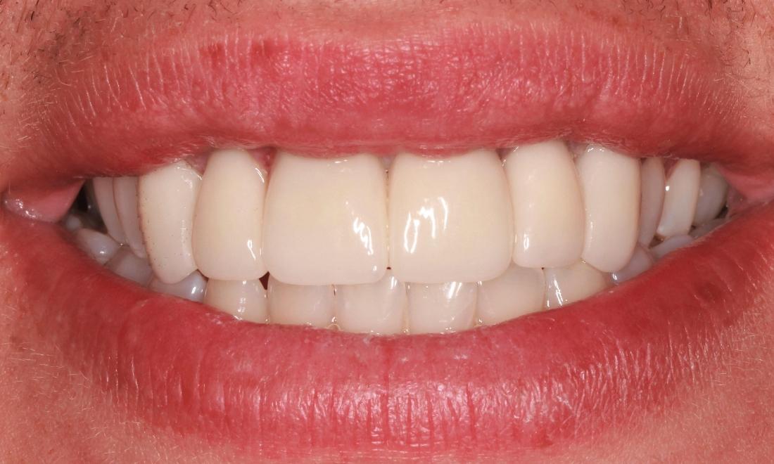 Patient teeth after receiving cosmetic crowns done in Springfield Missouri