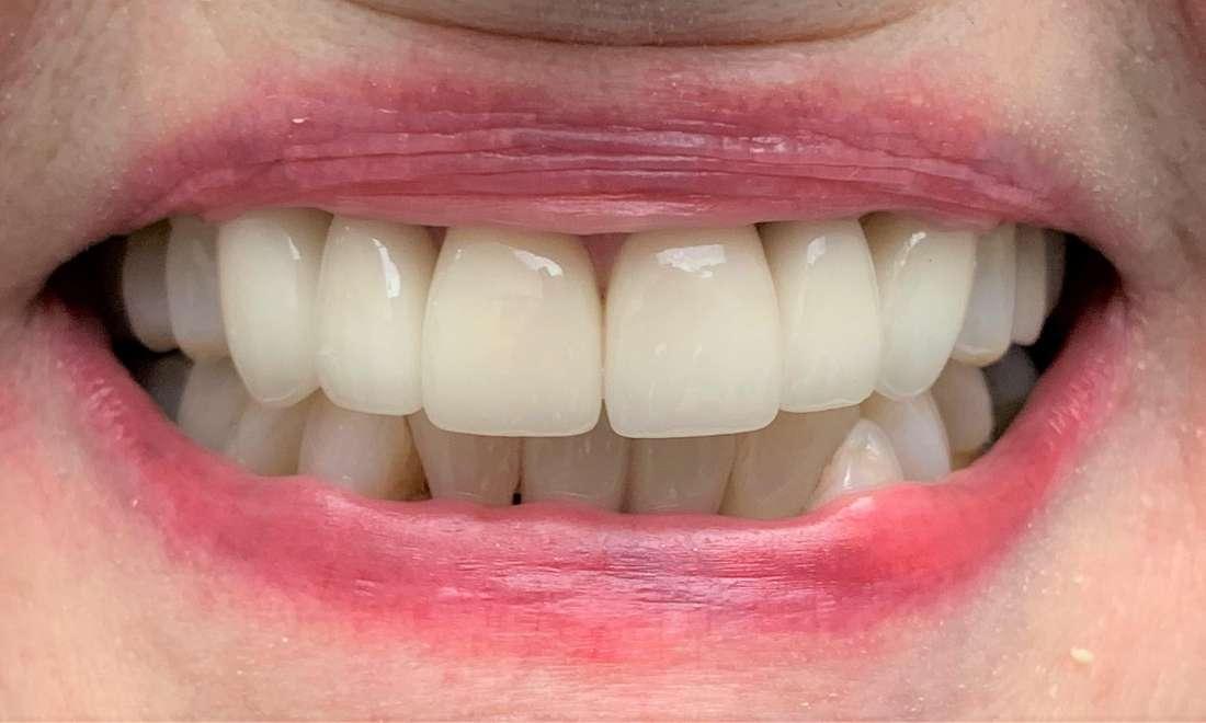 patient after getting all Ceramic Crowns done in Springfield, Missouri