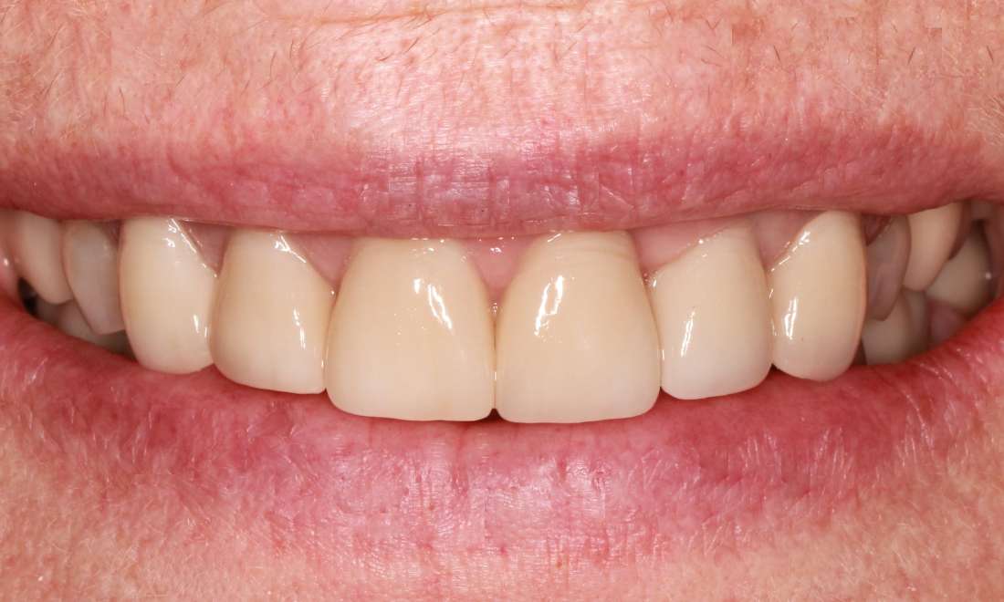 patient teeth after receiving dental crowns in Springfield, MO