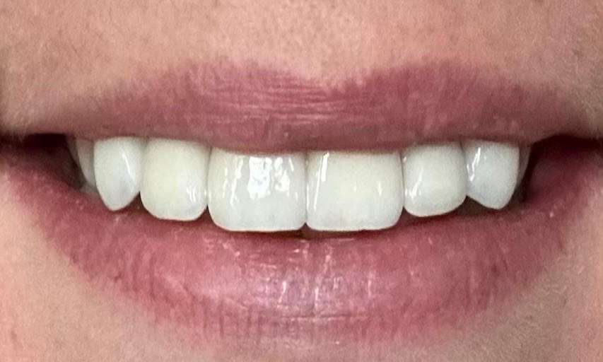 Springfield MO dental patient after crowns