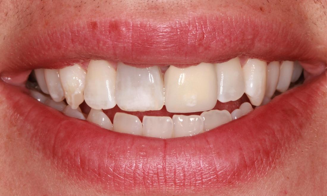 Patient teeth before cosmetic crowns in Springfield Missouri