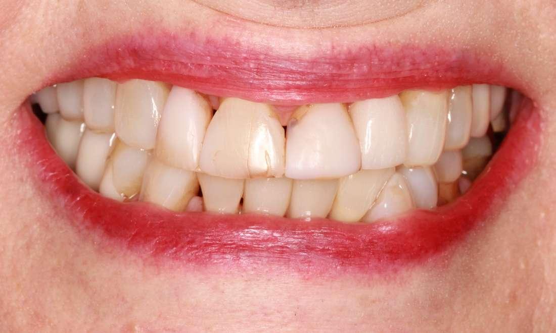 patient with poorly aged veneers and restorations