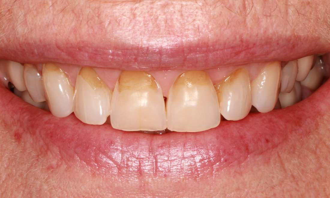 Patient teeth before receiving crowns in Springfield, MO