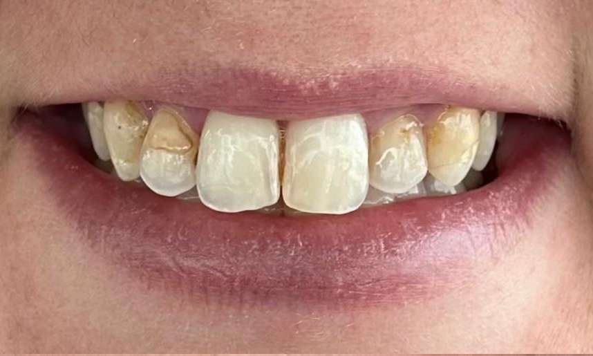 Patient teeth without crowns