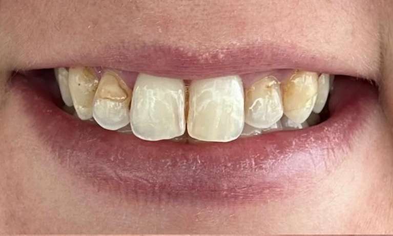 Patient teeth without crowns